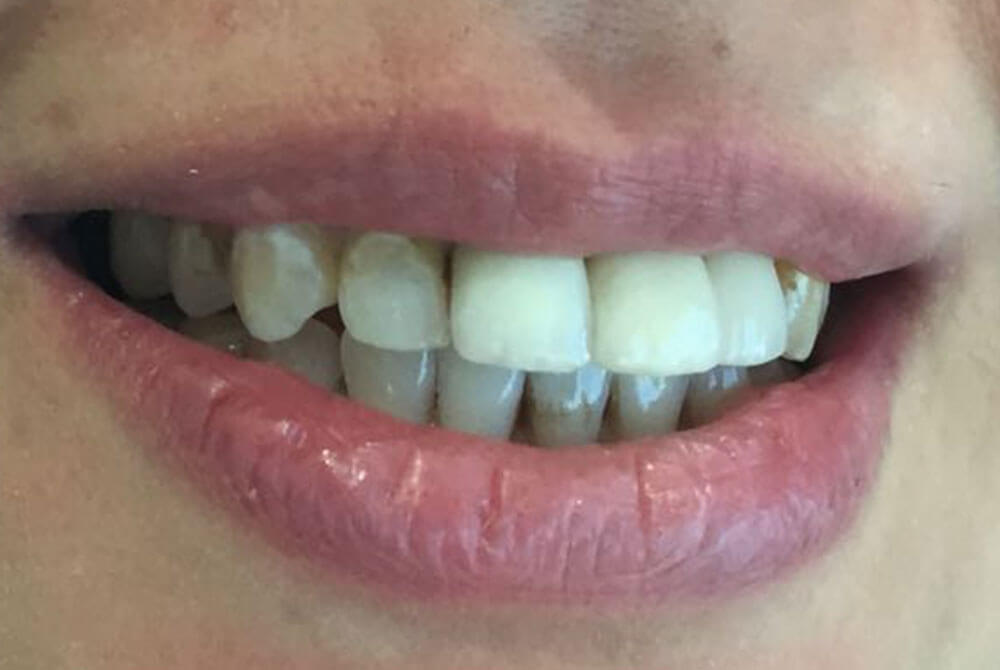 Zirconia Crowns Zirconia Crowns
