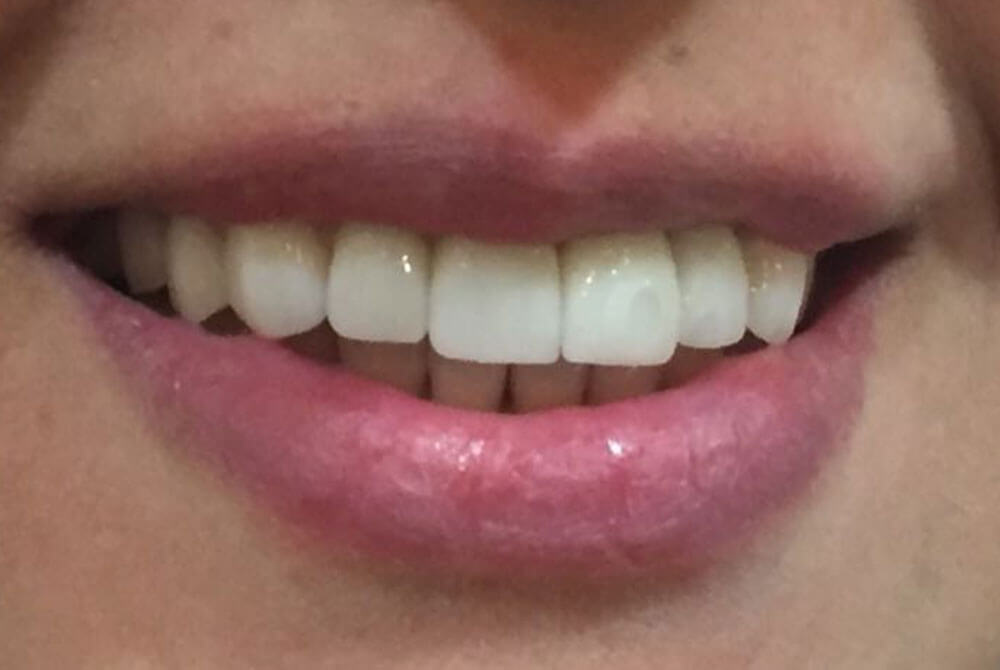 Zirconia Crowns Zirconia Crowns