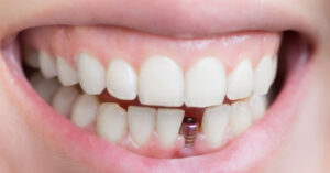 Lost a Tooth Here’s How Single Tooth Implant Can Benefit You