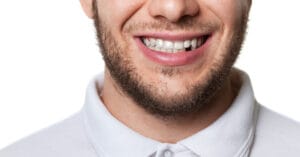 Immediate loaded implants – a Royal replacement for your missing tooth | Dental Implants in Dubai