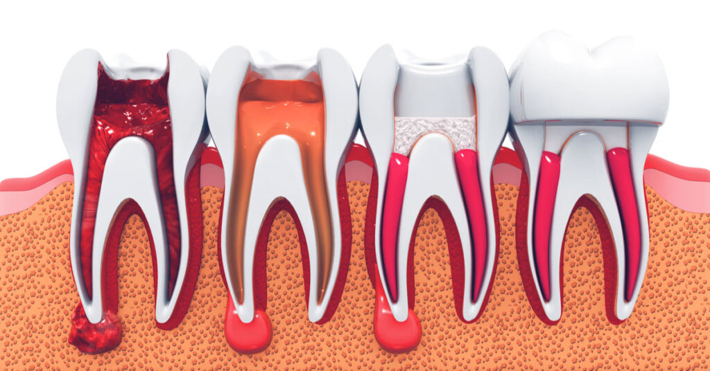 Root canal a cause for Oral cancer – Vanquish the fear | Endodontics In Dubai
