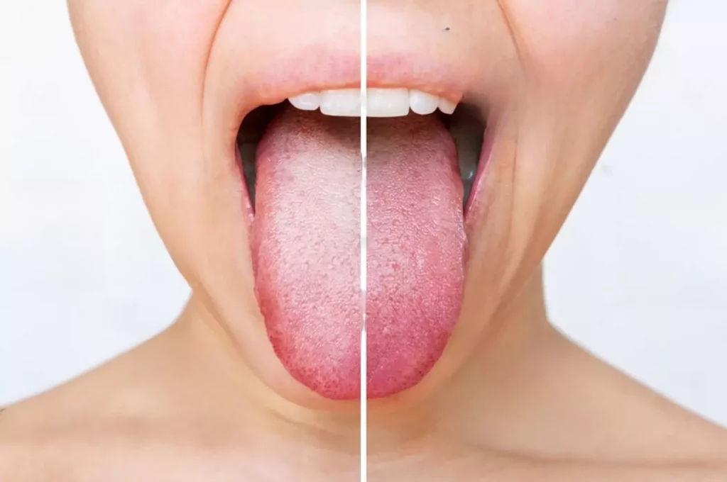 white tongue