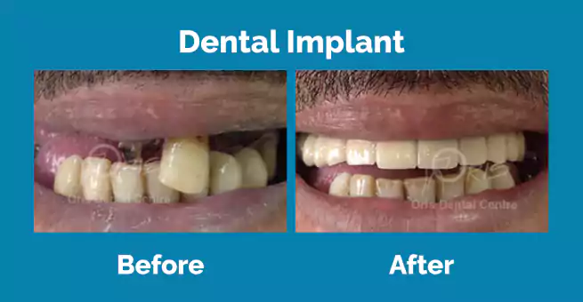 dental-implant2