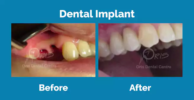 dental-implant3