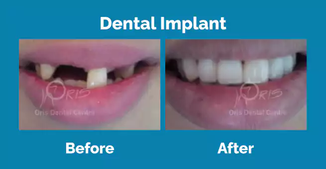 dental-implant4