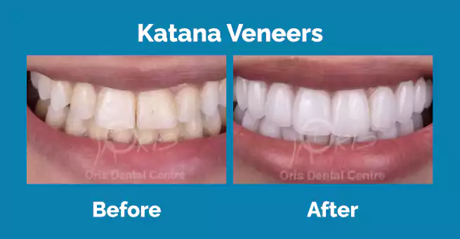 katana-veneers1