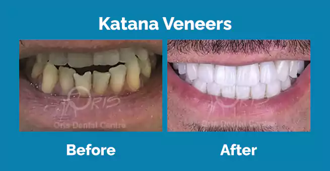 katana-veneers2