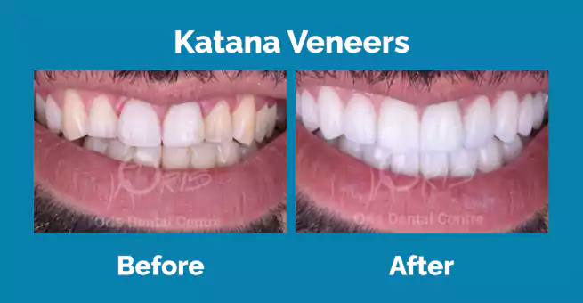 katana-veneers3