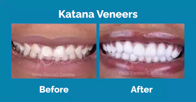 katana-veneers4