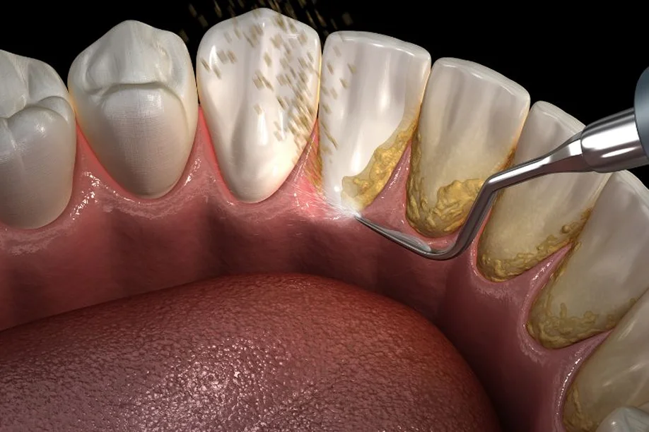 How To Remove Plaque From Teeth