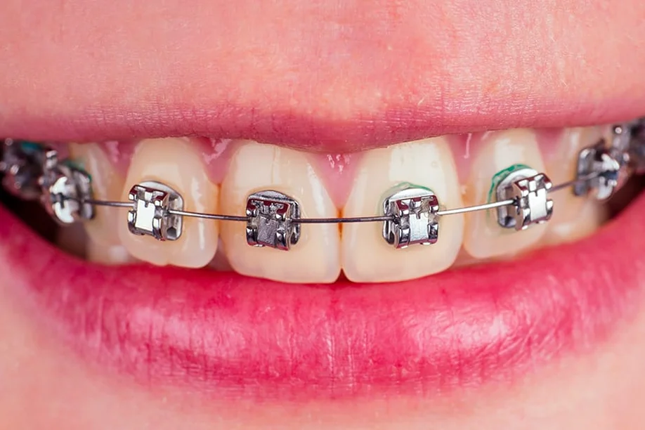 Self-Ligating Braces in Dubai
