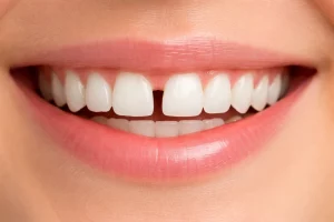 Teeth Gap Filling in Dubai