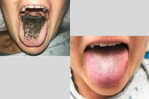 Black Hairy Tongue Image