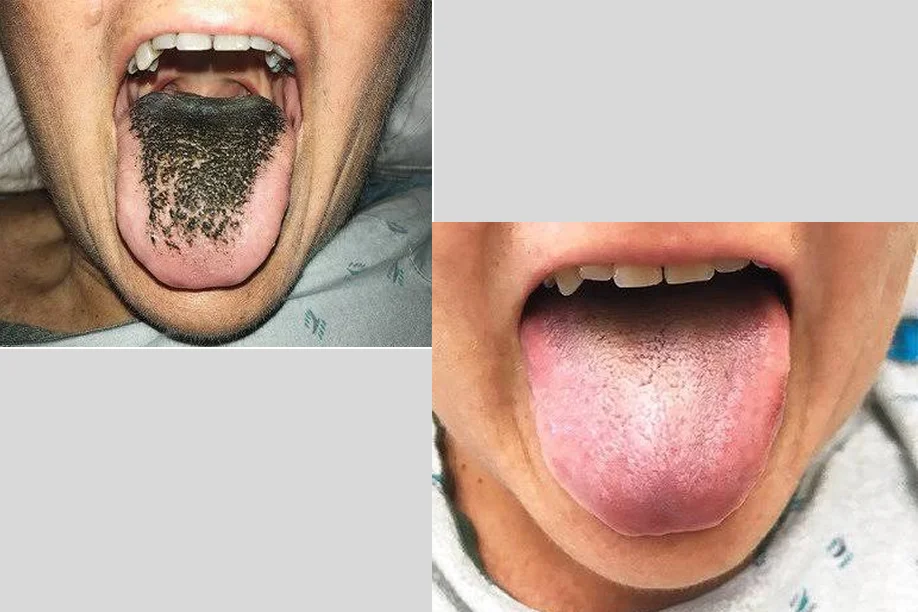 Black Hairy Tongue Image