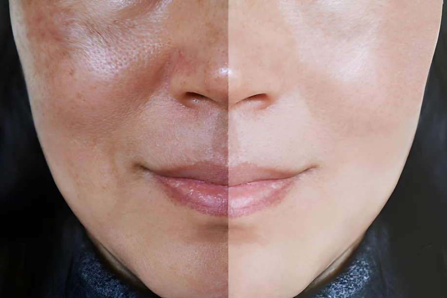 Open Pores Treatment