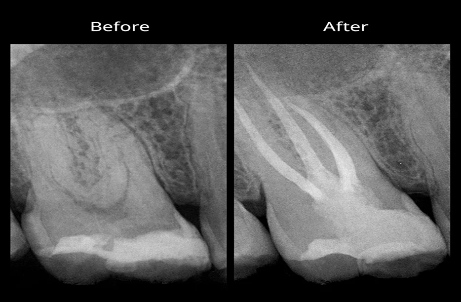 Pictures of Root Canal Before and After