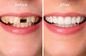 Root Canal Before and After