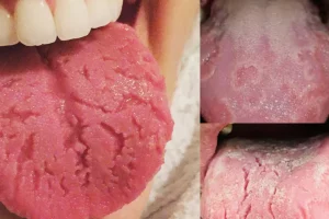 Fissured Tongue | Cracked Tongue