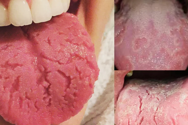 Fissured Tongue | Cracked Tongue