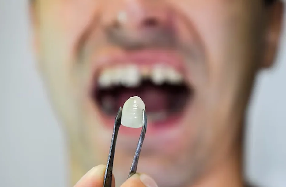 How To Fix Missing Teeth Without Implants