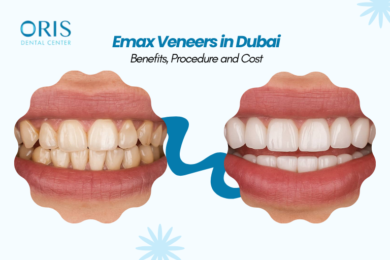 Emax Veneers in Dubai