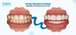 Emax Veneers in Dubai