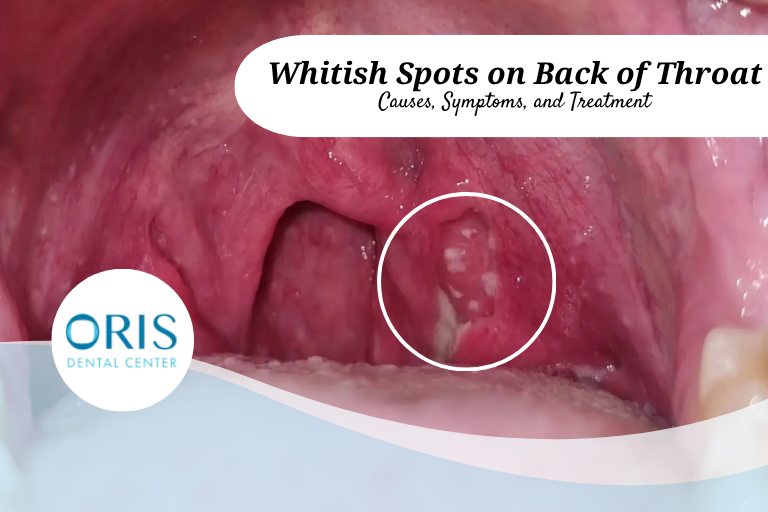 Whitish Spots on Back of Throat