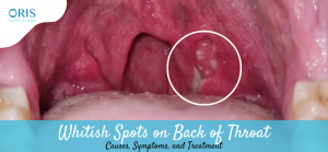 Whitish Spots on Back of Throat