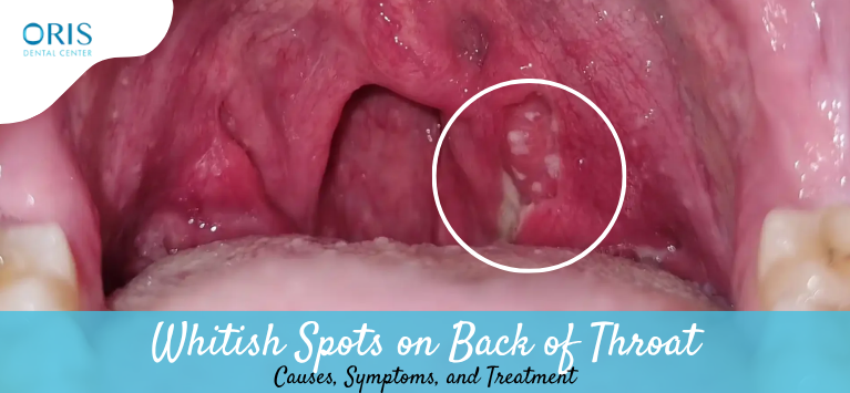 Whitish Spots on Back of Throat