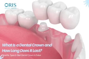 Best Dental Crown in dubai
