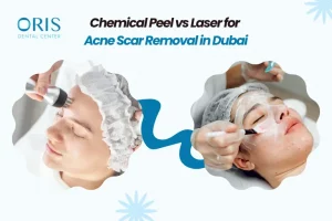 Chemical Peel vs Laser for Acne Scar Removal in Dubai